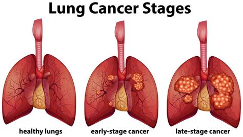 Diagram showing lung cancer stages 301312 Vector Art at Vecteezy