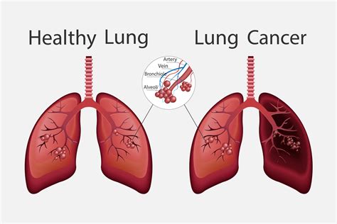 Healthy Lungs Vs Unhealthy Lungs