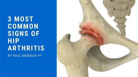 Arthritis Hip Pain Location Chart