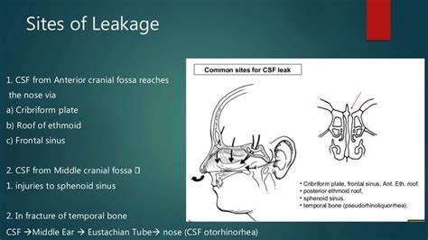 Csf Rhinorrhea - Overview