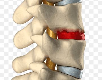 Discogenic Low Back Pain • Peak Physio