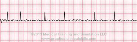 Diagnosing Atrial Fibrillation – How To Know If You Have It