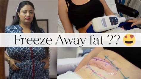 Freeze Fat Cells : Shape Your Body With Coolsculpting - YouTube