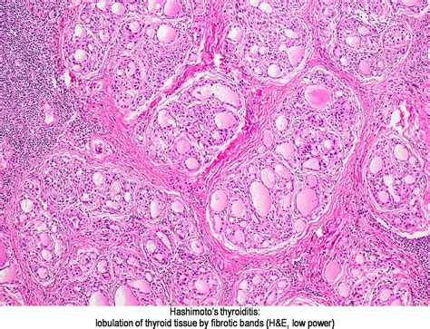 Pathology Outlines - Hashimoto thyroiditis