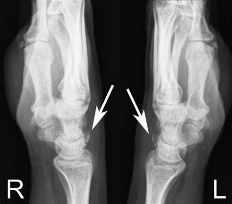 Triquetral Bone : Information and translations of triquetral bone in the most comprehensive ...