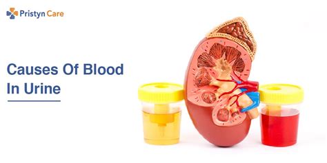 Causes Of Blood In Urine - Pristyn Care