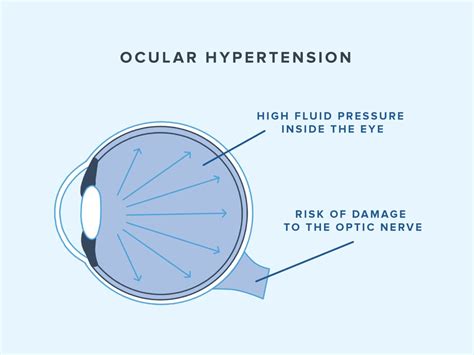 What’s a Normal Eye Pressure Range? | Warby Parker