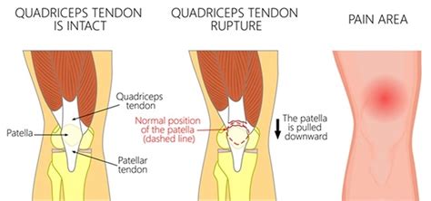 Ruptured quadriceps tendon causes, symptoms, diagnosis, treatment ...