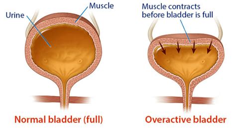 Overactive Bladder (OAB) - Female - ASUI