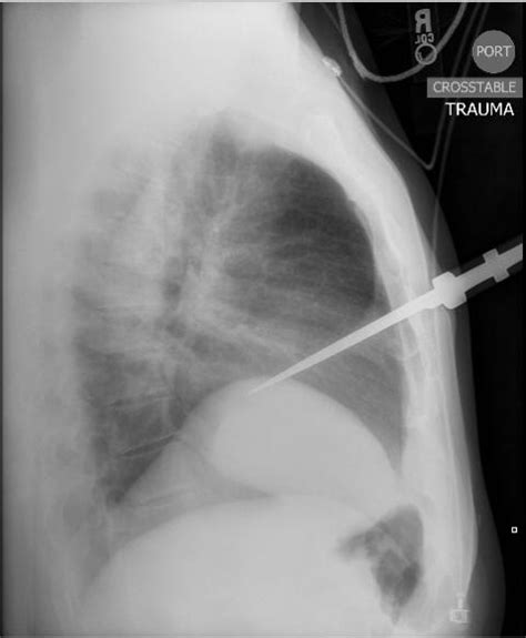 Penetrating Chest Trauma – Knife in Chest | RADIOLOGYPICS.COM