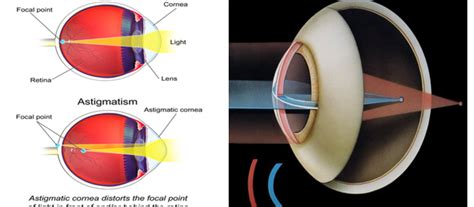 Astigmatism From Computer Screen : Alignment Challenges In The Context ...