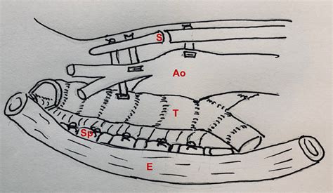 Posterior and anterior tracheopexy combined with anterior aortopexy. S ...