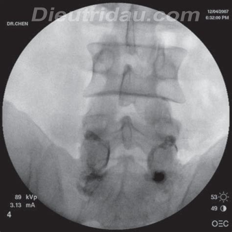 Zygapophyseal Joint Injection - Pain Management