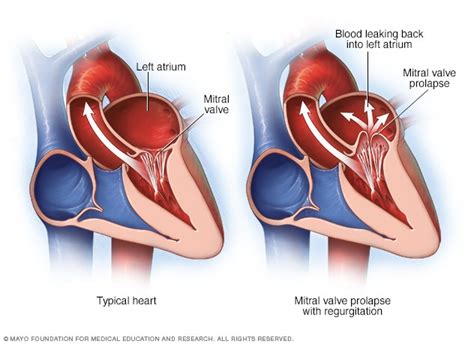 Mitral valve regurgitation - Symptoms and causes - Mayo Clinic