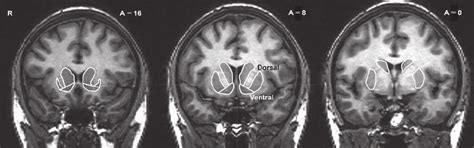 3 Ventral and dorsal striatum . (as specified by Mawlawi et al. , 2001.) | Download Scientific ...