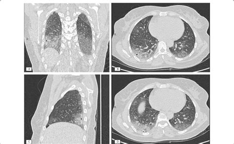 CT scan five days after cryobiopsies. a Lateral pneumatocele (arrows)... | Download Scientific ...