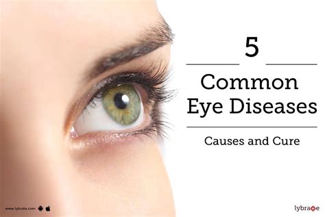 5 Most Common Eye Diseases: Causes and Cure - By Bharti Eye Hospitals | Lybrate