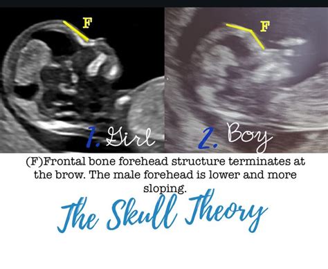 The Skull Theory - The Physical Attributes of your Baby's Skull Matter | Ultrasound gender ...