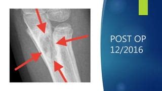 Posttraumatic radio ulnar synostosis | PPT