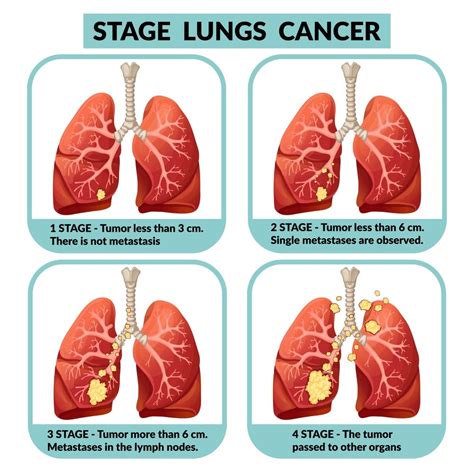 Stage 4 Lung Cancer Treatments - CancerProTalk.com