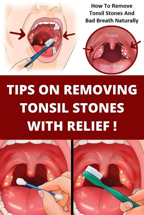 White Spots On Tonsils Treatment