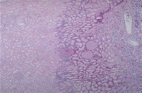 Renal Pathology