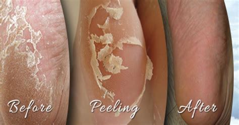 Home Remedies For Peeling Skin On Your Feet - TOP 5 DIY