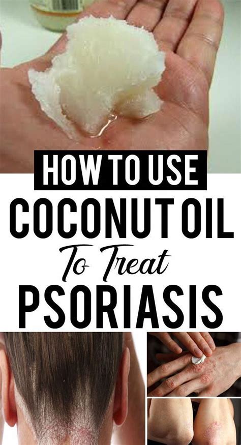 natural herbal remedies | Coconut oil for psoriasis, Psoriasis skin, Psoriasis