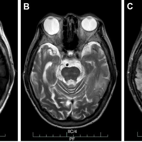 First brain MrI. Note: Left occipital lobe lesion showed abnormal t1... | Download Scientific ...