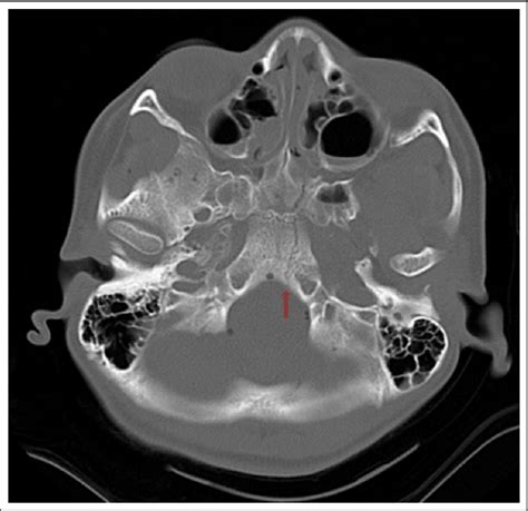 Figure 1 from Pediatric Longitudinal Clivus Fracture | Semantic Scholar