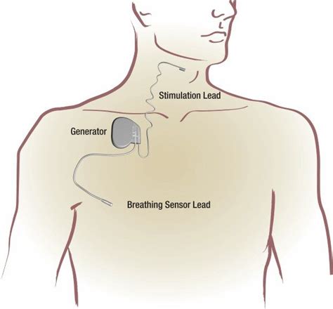 Inspire Therapy for Sleep Apnea - Hackensack Sleep & Pulmonary Center