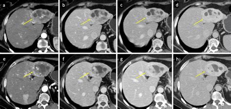 Multicystic hemangioma. CT imaging shows a HH with a complex mass... | Download Scientific Diagram