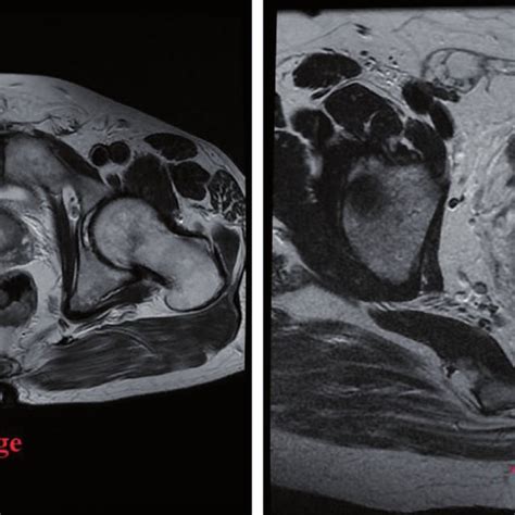 EMVI-extramural venous/vascular invasion (T2 weighted MR images ...