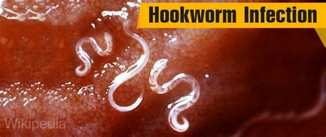 Hookworm Infection - Causes, Symptoms, Diagnosis, Treatment and Prevention