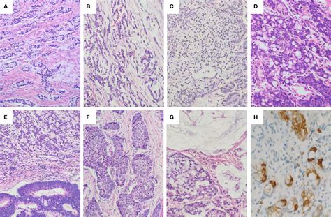 Esophageal Adenocarcinoma Histology