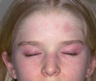 Juvenile Dermatomyositis: Background, Pathophysiology, Etiology