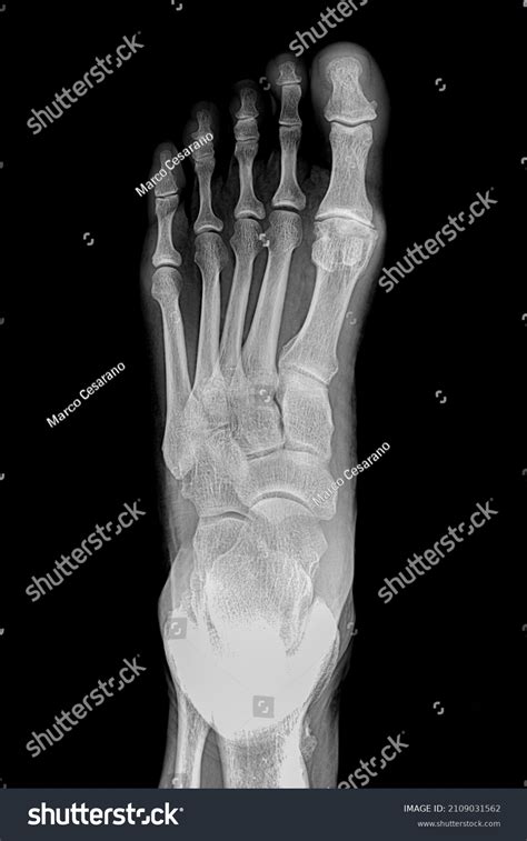 Foot Xray Anatomy