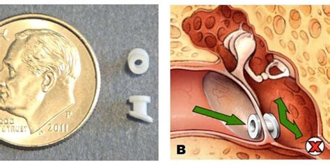 Guide: Not all kids need ear tubes to relieve fluid