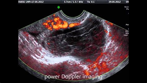 Hemorrhagic Ovarian Cyst on Transvaginal Ultrasound - YouTube