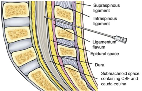 Intrathecal Access/Injection (Spinal) – Technique and Overview - The Procedure Guide