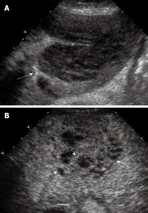 Liver Lesions Ultrasound