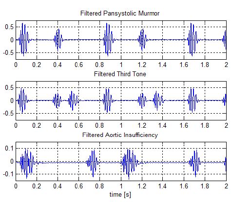 a) pansystolic murmur; b) third tone and c) aortic insufficiency after ...