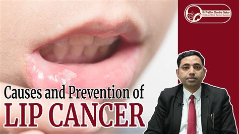 Lip cancer - Dr. Prabhat Chandra Thakur