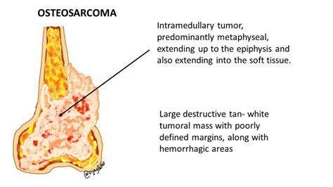 OSTEOSARCOMA: Pathological features - Pathology Made Simple