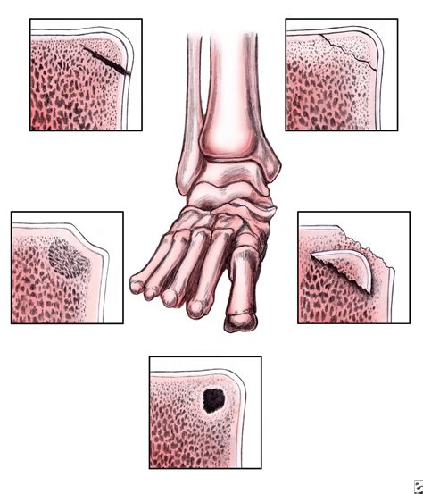 The Foot and Ankle Tribune: OLT (Osteochondral lesions of the talus)