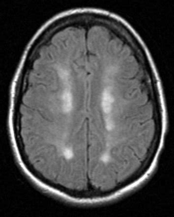 Watershed cerebral infarction | Radiology Reference Article | Radiopaedia.org