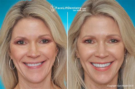 Correcting a Worn, Slanted, Crooked Smile - Face Lift Dentistry