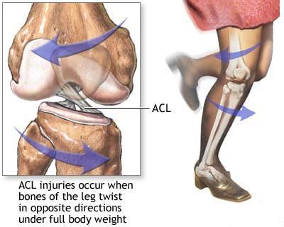 ACL Injury Prevention