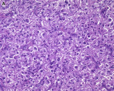 Atypical Fibroxanthoma Revisited - Surgical Pathology Clinics