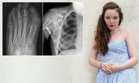 Girl, 17, battling rare disease that turns muscle into a second ...